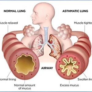 Chronic Ashtma