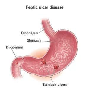 Peptic Ulcer & Duodenal Ulcer