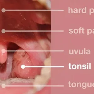 Tonsilitis