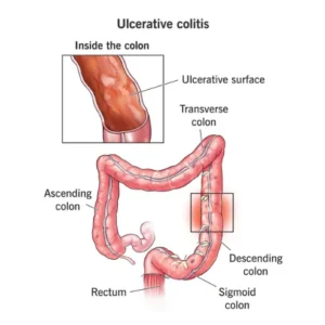 Ulcerative Clotis