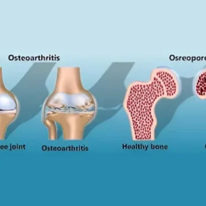 Osteoarthritis & Osteoporosis