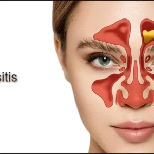 Sinusitis