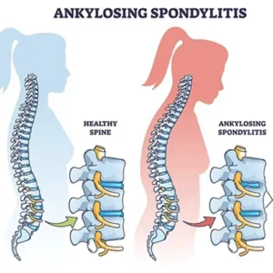 Ankylosing Spondylitis