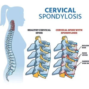 Cervical And Lumber Spondylosis