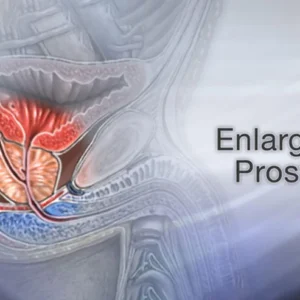 Prostate Enlargement